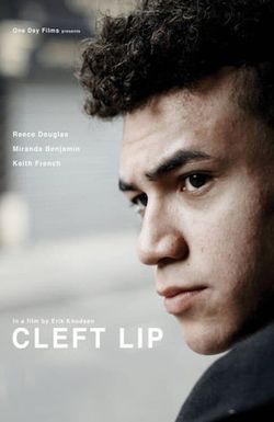 Cleft Lip