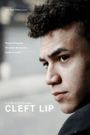 Cleft Lip